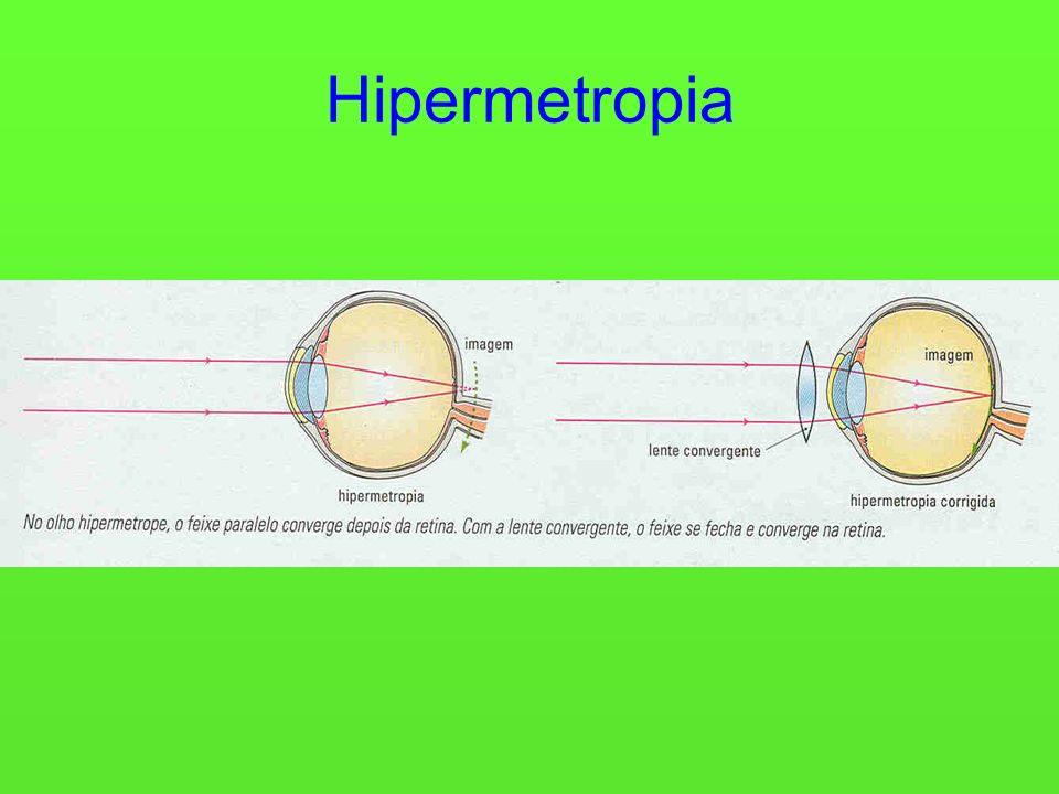 Hipermetropia