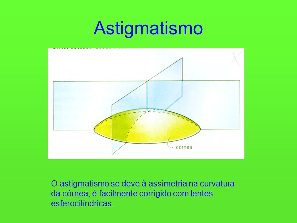 Astigmatismo O astigmatismo se deve à assimetria na curvatura da córnea, é facilmente corrigido com lentes esferocilíndricas.