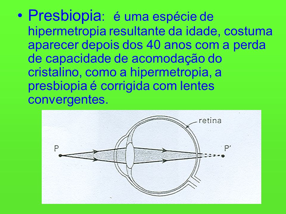 Presbiopia : é uma espécie de hipermetropia resultante da idade, costuma aparecer depois dos 40 anos com a perda de capacidade de acomodação do cristalino, como a hipermetropia, a presbiopia é corrigida com lentes convergentes.