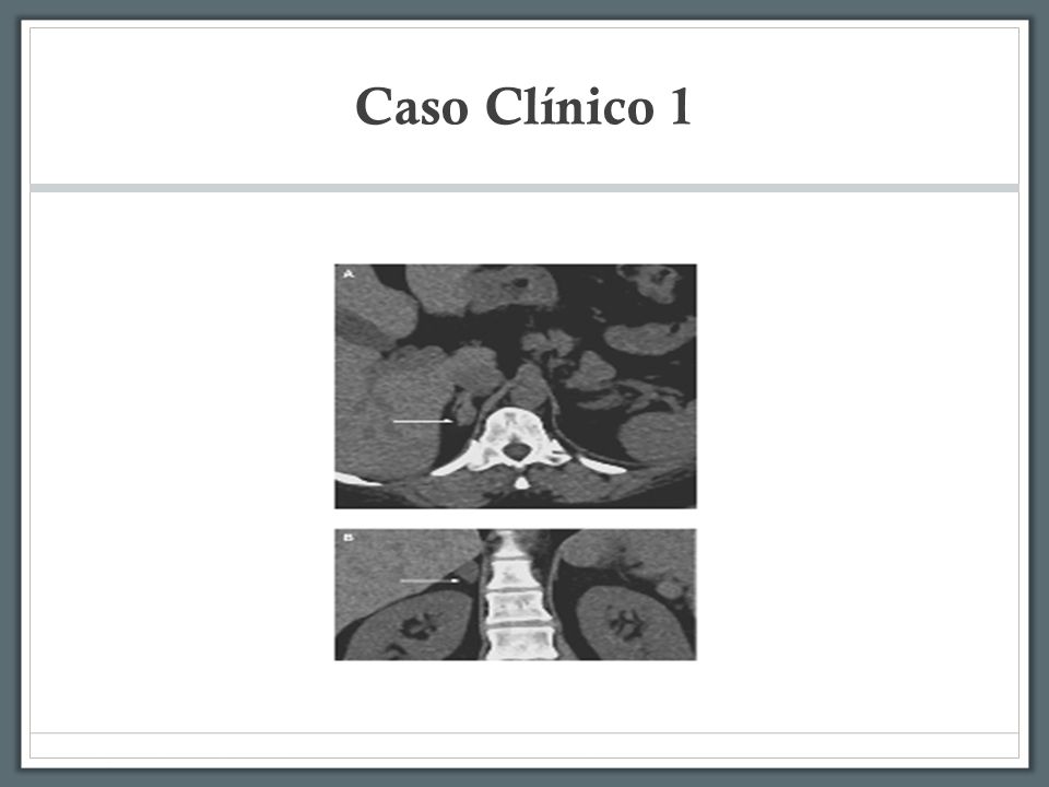 HIPOMAGNESEMIA CASO CLINICO hipomagnesemia caso clinico: