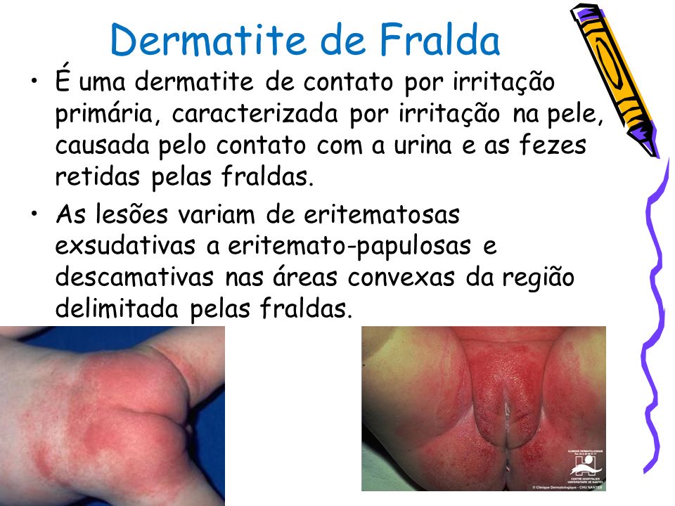 Resultado de imagem para dermatite de fralda