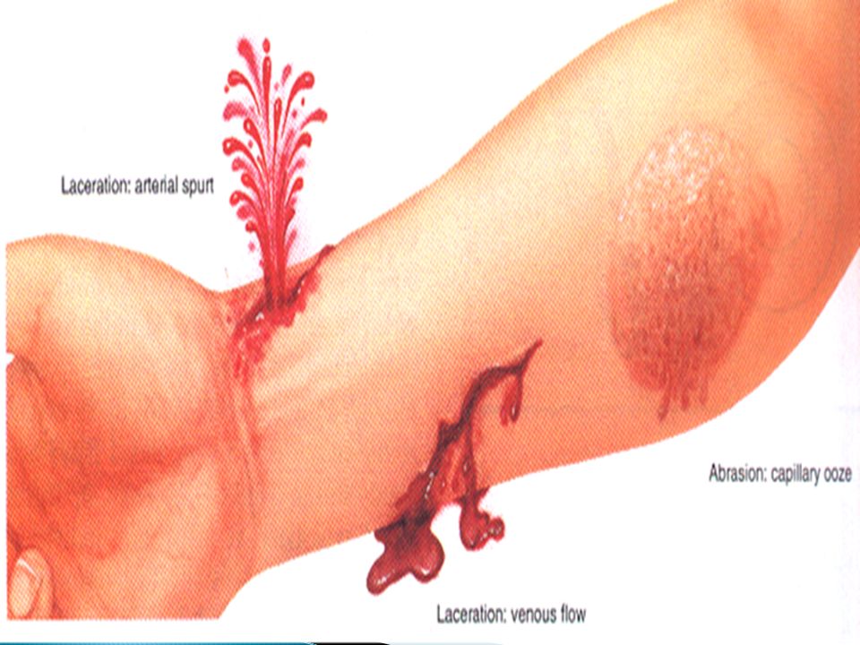 La hemorragia es un trastorno caracterizado por la extravasación de sangre del lecho vascular.