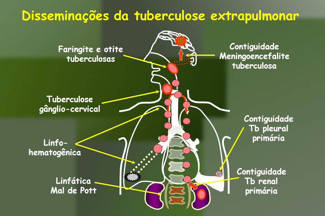Resultado de imagem para tuberculose extrapulmonar