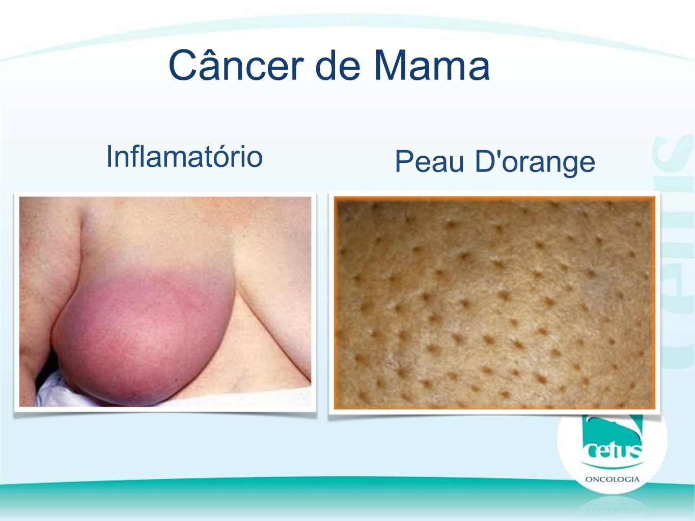 Inflamatório Câncer de Mama Peau D orange