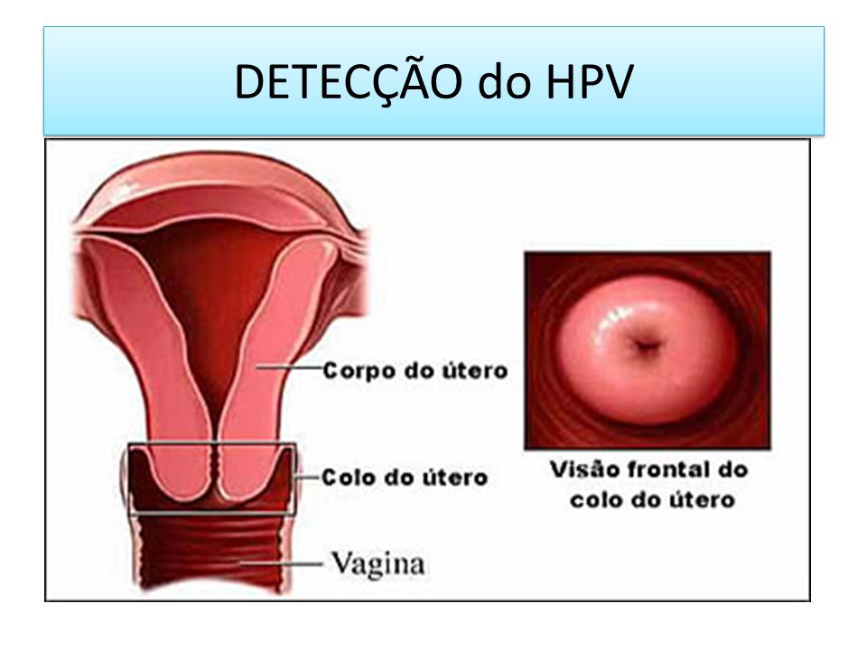 DETECÇÃO do HPV