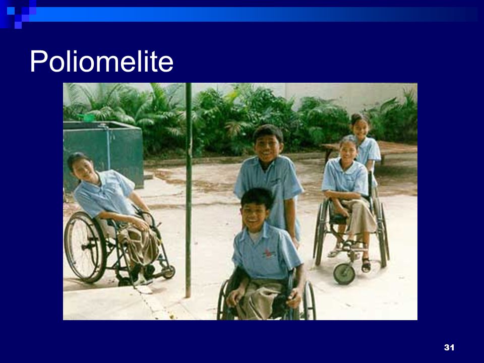 31 Poliomelite