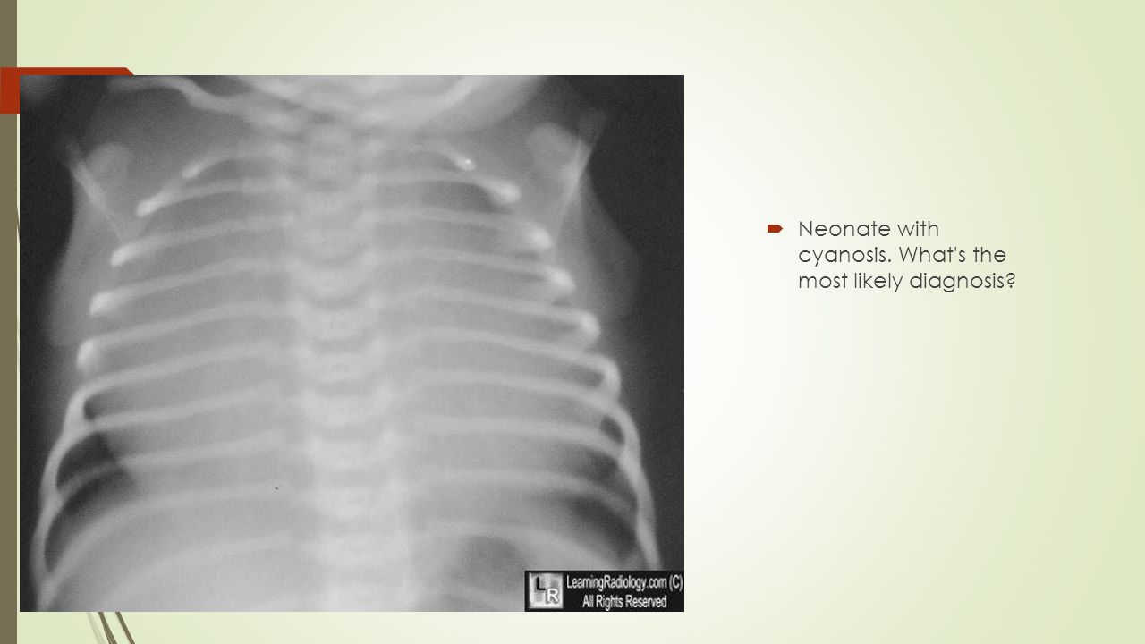 Viagra Neonate Pulmonary