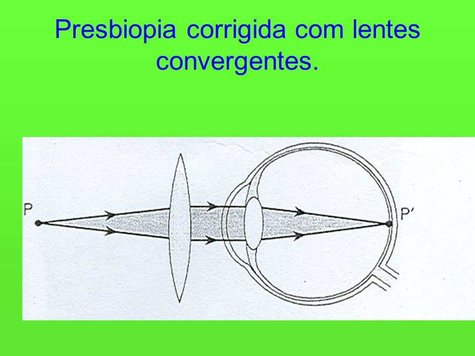 Presbiopia corrigida com lentes convergentes.