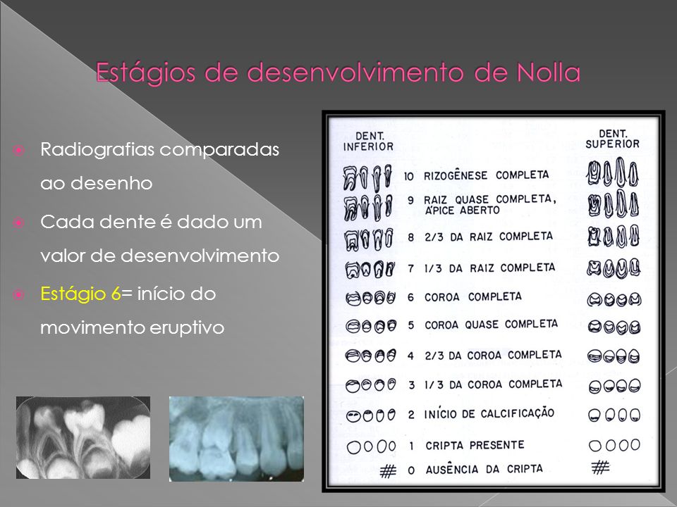 Radiografias comparadas ao desenho Cada dente é dado um valor de desenvolvimento Estágio 6= início do movimento eruptivo