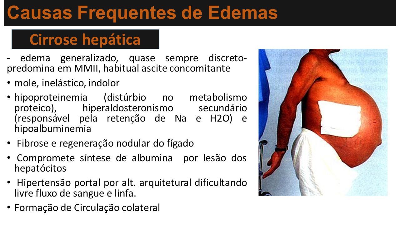 Edema Semiologia Médica MED31, 2020 Orientador : DR. Prof. Lopez Martins. -  ppt carregar