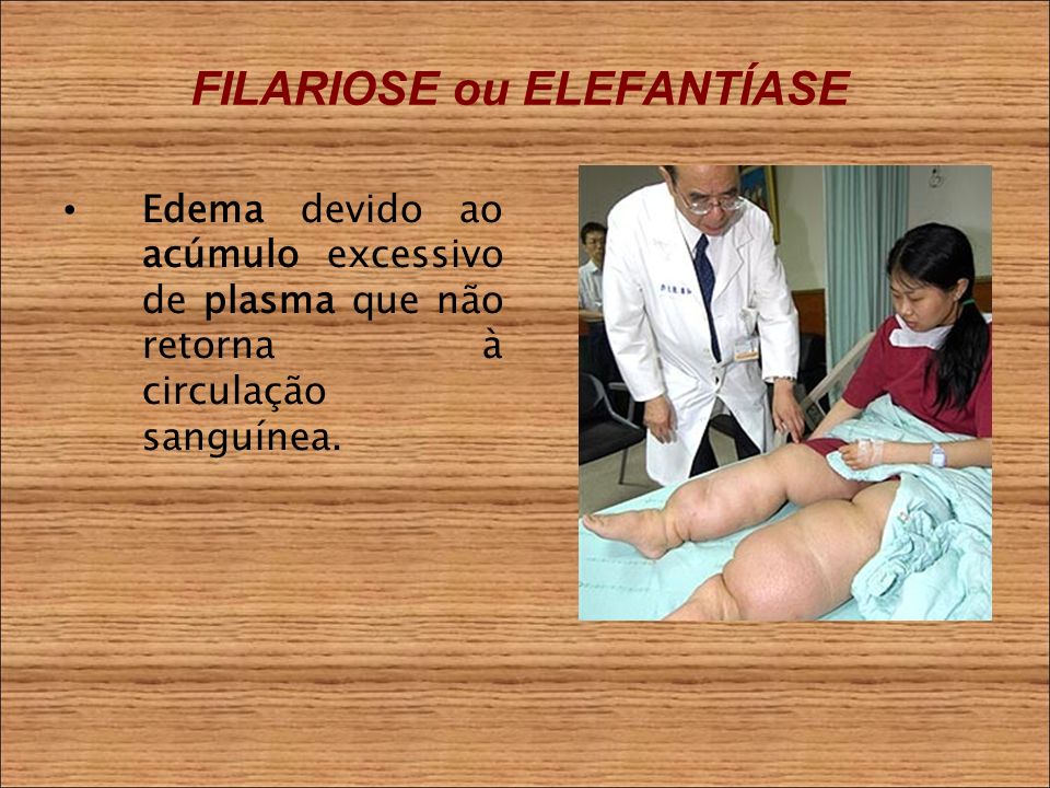 FILARIOSE ou ELEFANTÍASE Edema devido ao acúmulo excessivo de plasma que não retorna à circulação sanguínea.