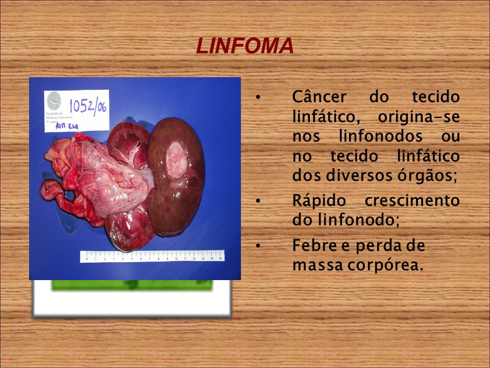 LINFOMA Câncer do tecido linfático, origina-se nos linfonodos ou no tecido linfático dos diversos órgãos; Rápido crescimento do linfonodo; Febre e perda de massa corpórea.