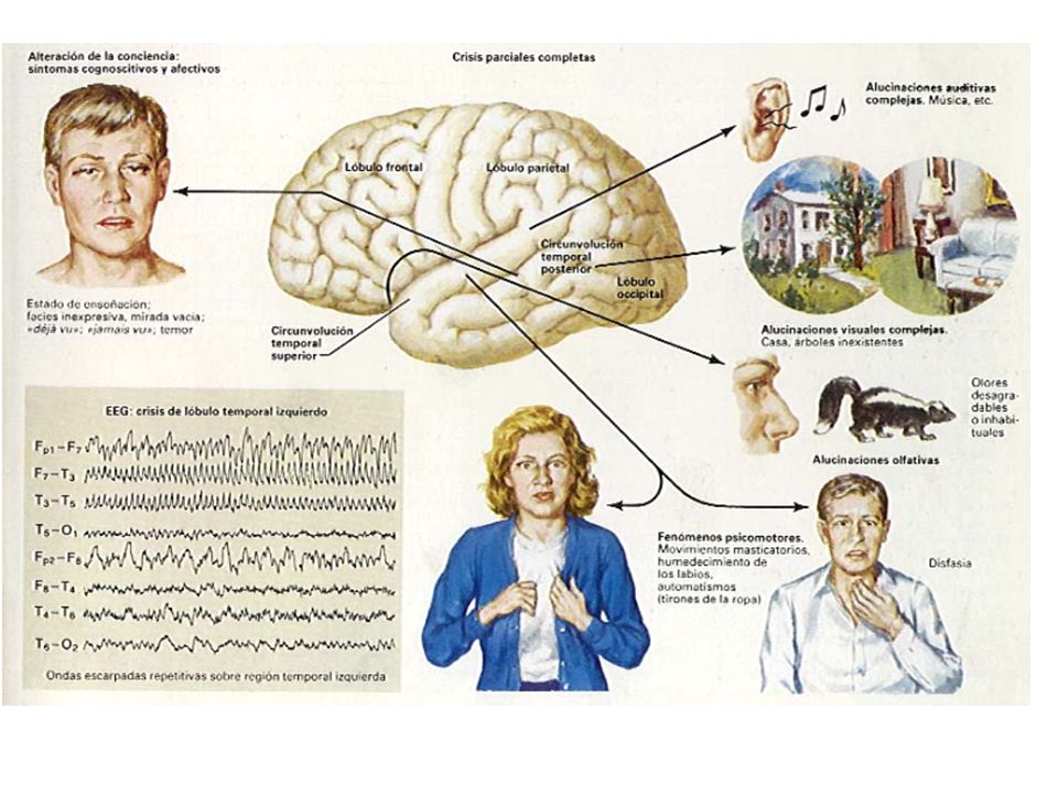 Нэо неврология эпилепсия остеопатия. Этиология эпилепсии. Патоморфология эпилепсии. Эпилепсия схема. Патогенез эпилепсии.