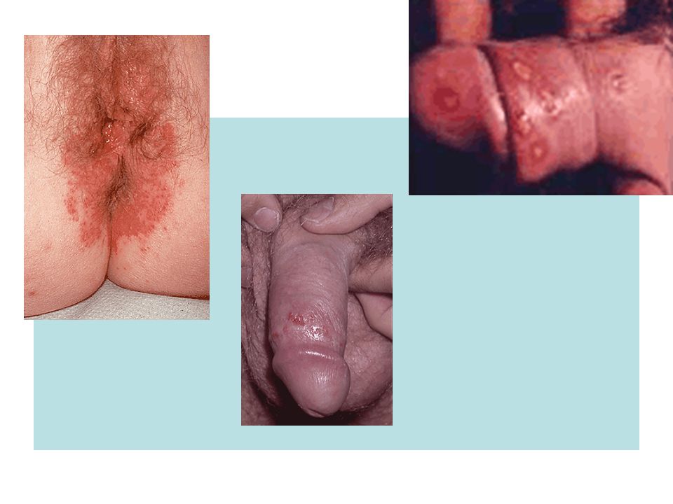 Herpes genital no inicio da gravidez