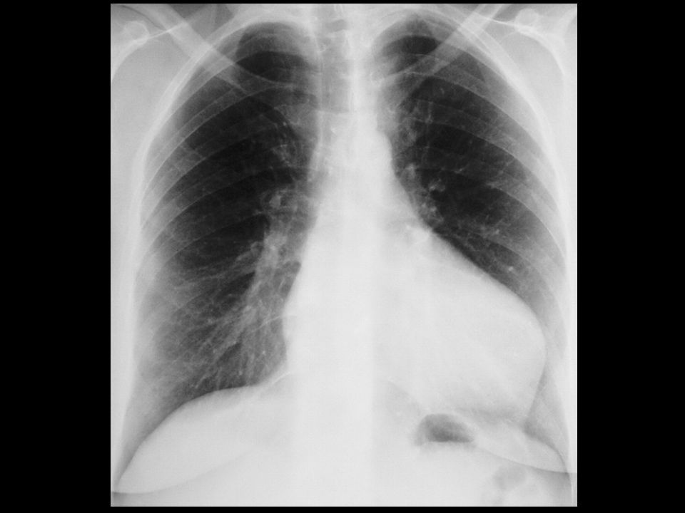 Границы расширены влево. Гипертрофия левого желудочка рентген. Рентгенограмма дилатация сердца. Гипертрофия левого желудочка флюорография.