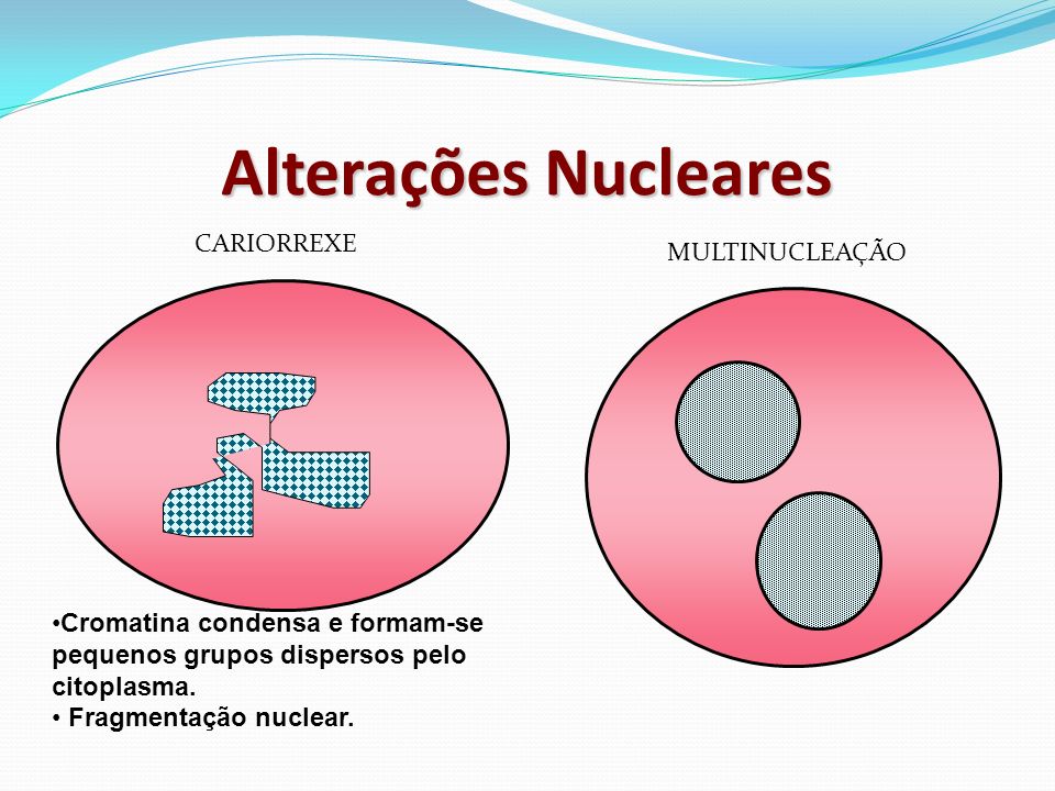 Alterações Nucleares CARIOMEGALIA Penetração de água dentro do núcleo VACUOLIZAÇÃO