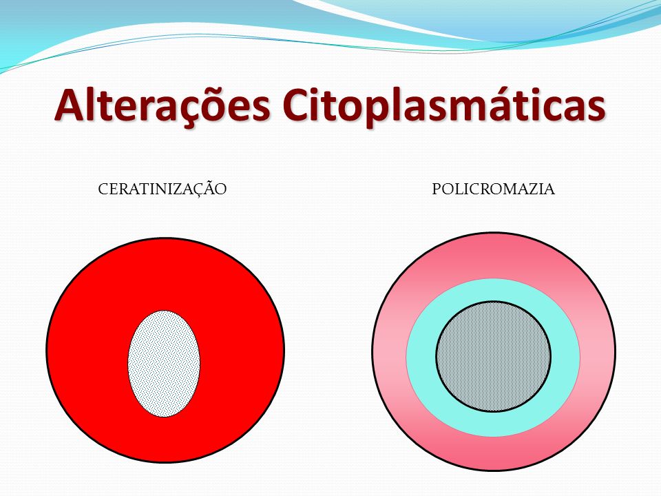 Alterações Citoplasmáticas VACUOLIZAÇÃO HALO PERINUCLEAR