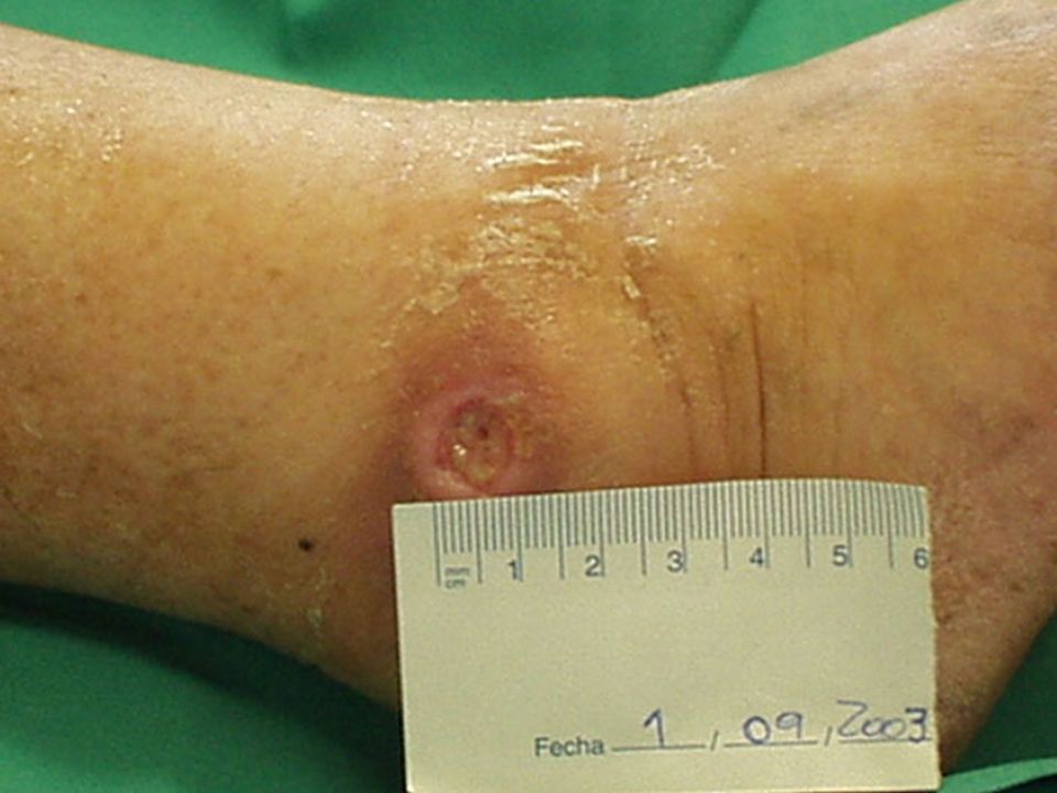 Cauzele și tratamentul durerii la venele din picioare - simptomatologia