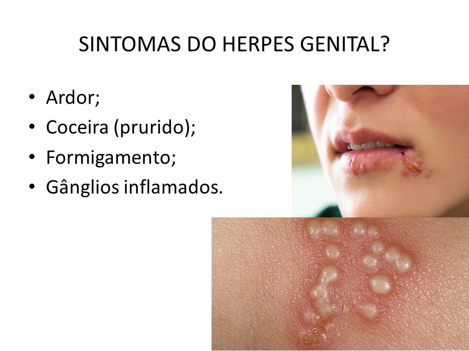 herpes genital feminina inicio